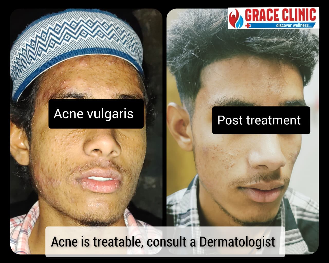 Acne Vulgaris Before and After Treatment