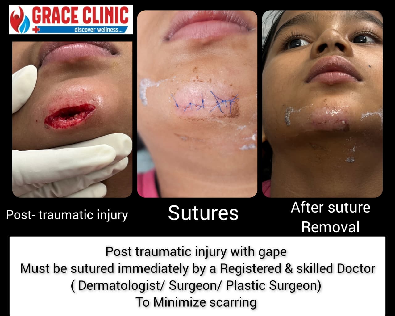 Post Traumatic Injury Suturing and Healing