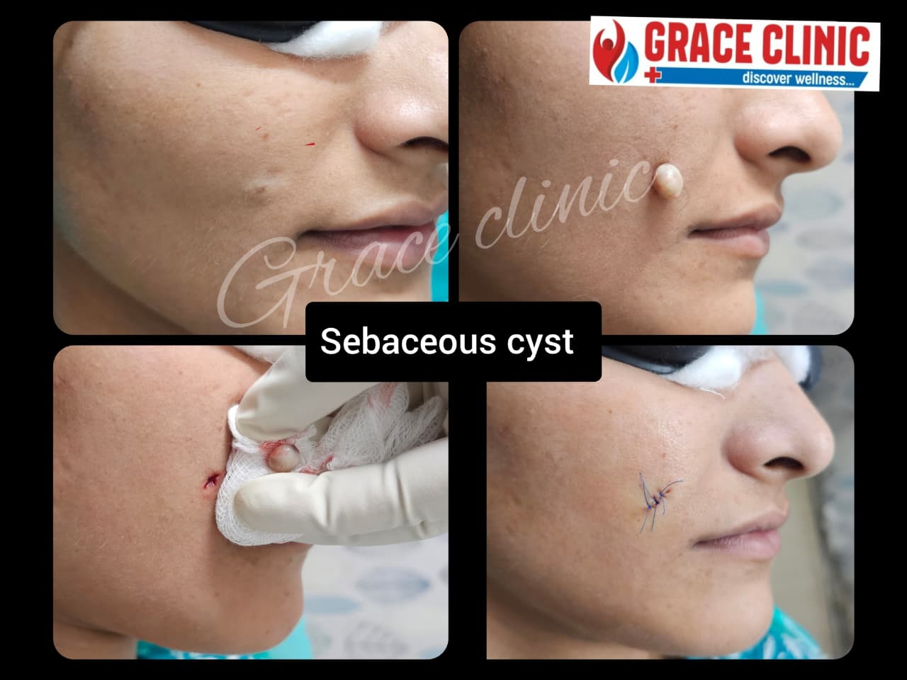 Sebaceous Cyst Removal Surgery