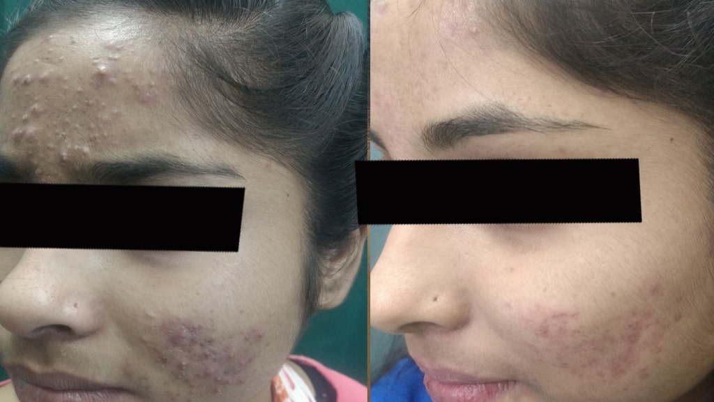 Before & After (ACNE)