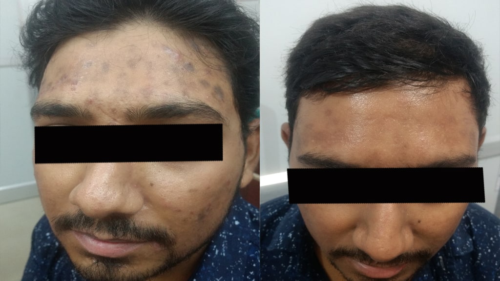 Before & After (ACNE)