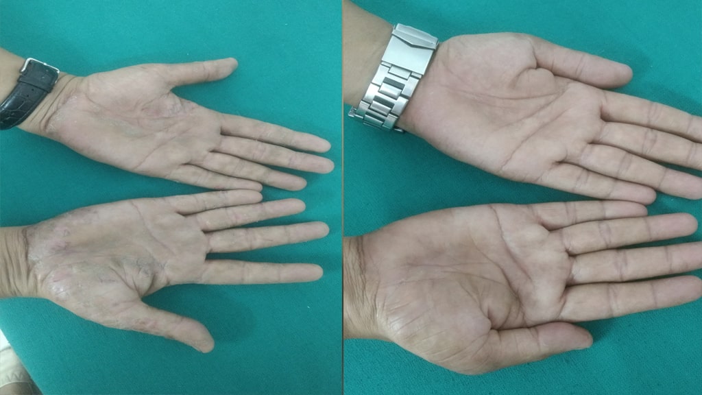 Before & After (ECZEMA)