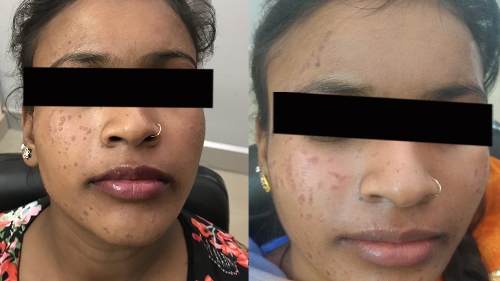 Before & After (PLAIN WART)