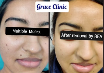 Before & After